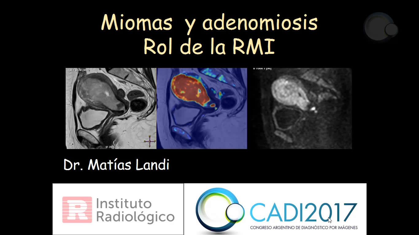 Miomas y adenomiosis. Rol de la Resonancia Magnética