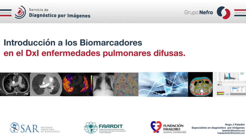 Biomarcadores e Inteligencia Artificial en enfermedades pulmonares difusas.