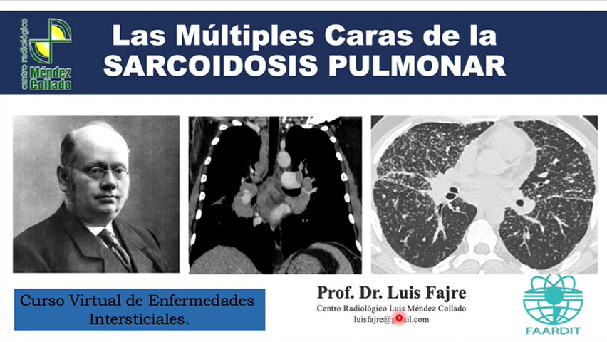 Las múltiples caras de la sarcoidosis pulmonar. 