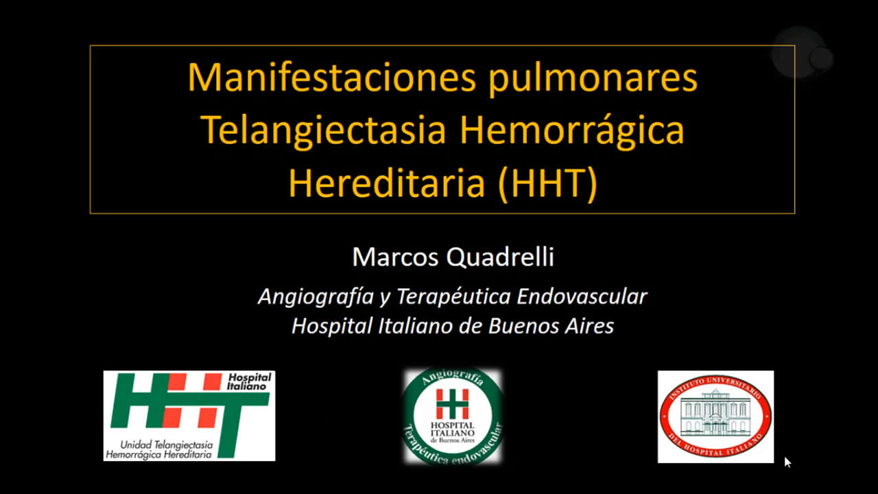 Manifestaciones pulmonares de la Telangiectasia Hemorrágica Hereditaria (Síndrome de Rendu‐Osler‐Weber)