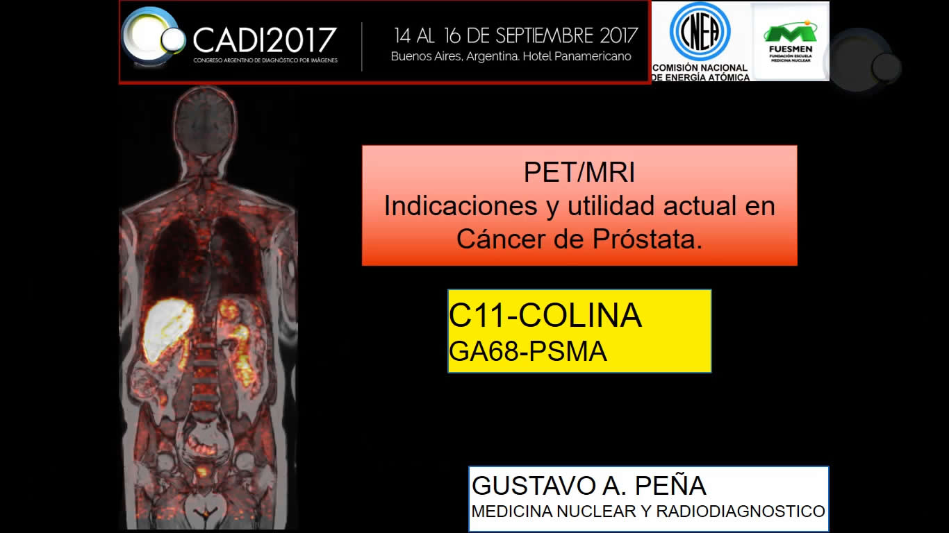 PET/MRI en cáncer de próstata